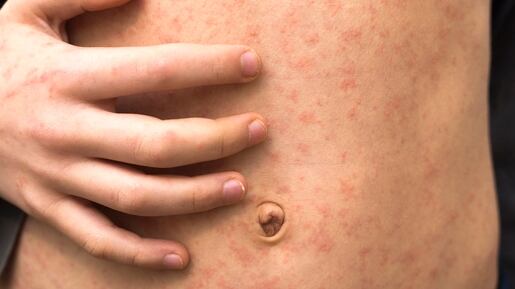 Measles causes a red rash, high fever and other symptoms.